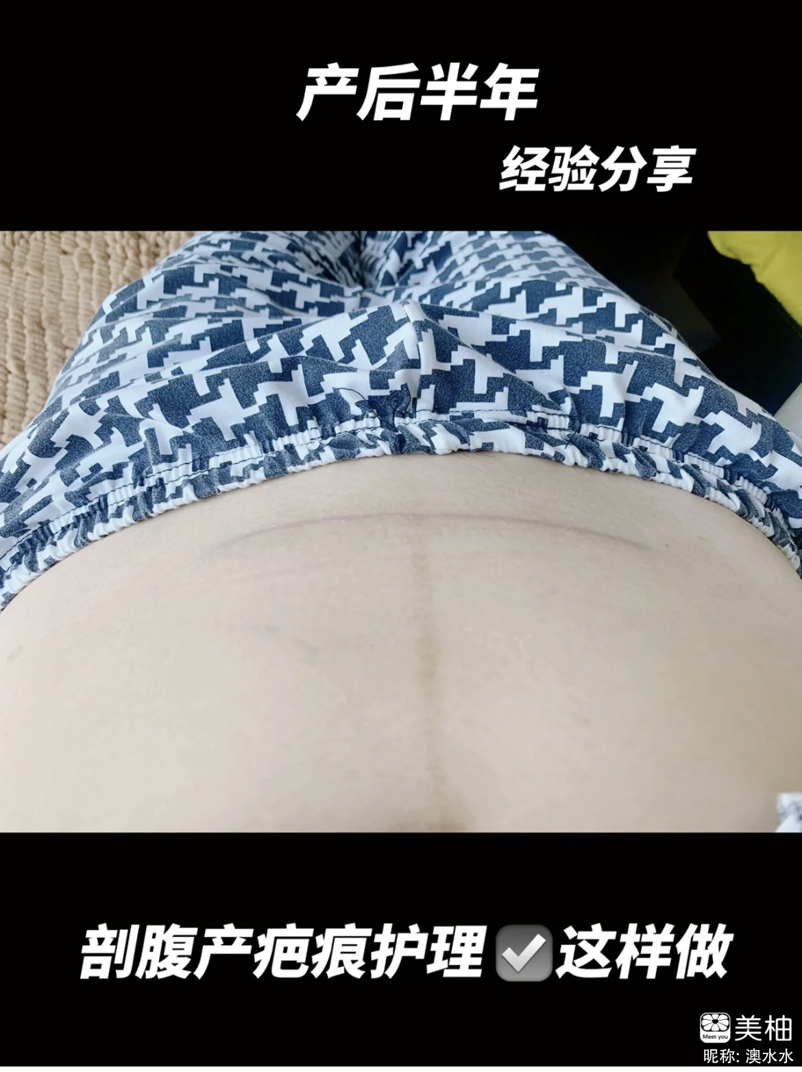 剖腹产后疤痕护理～无妊娠纹～