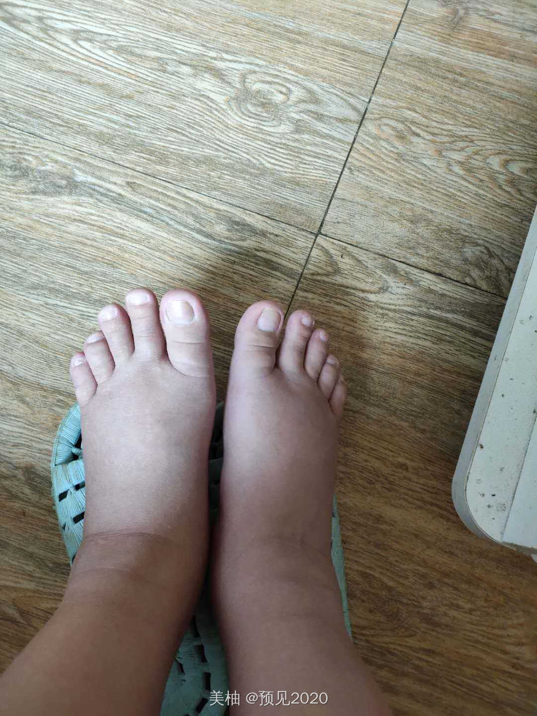孕期脚肿怎么办？？说说我缓解脚肿的方法。