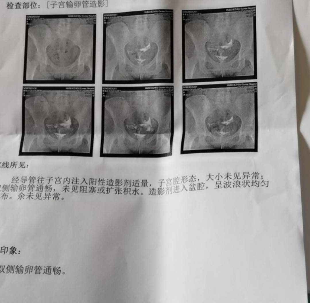 输卵管造影检查过程及体验