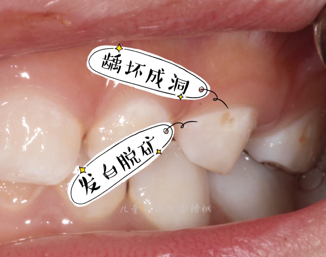 10个宝宝1个龋齿，可能和吃奶习惯有关