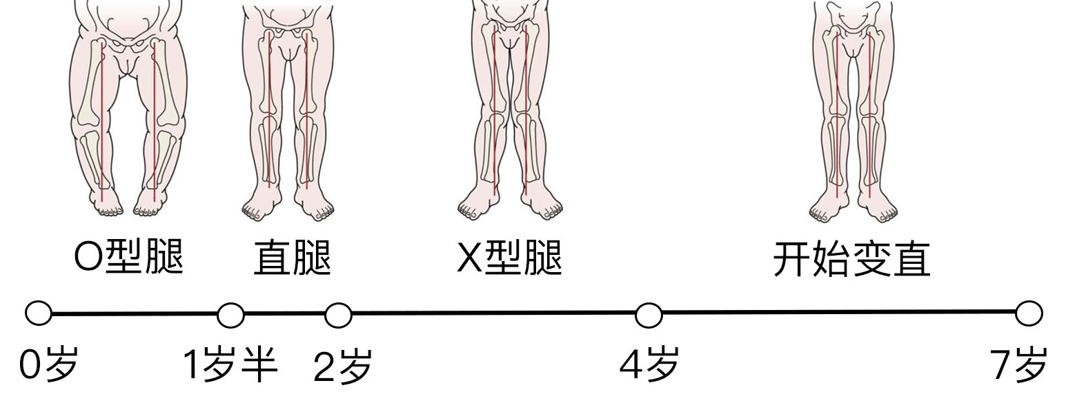 O型腿、X型腿……了解0～7岁孩子腿型发育规律