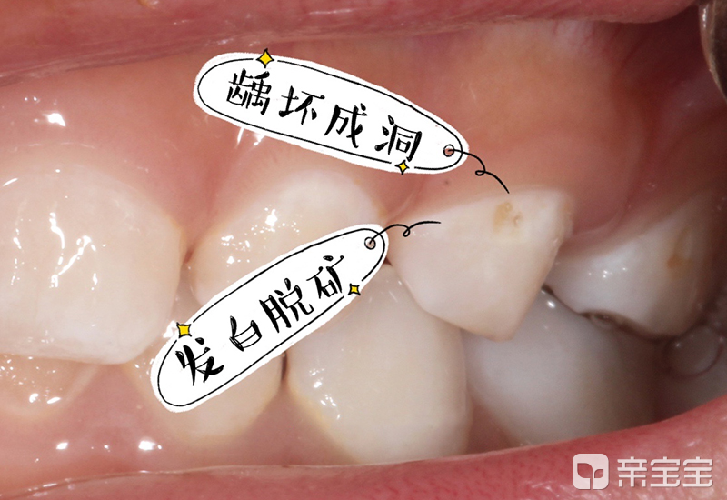 孩子牙齿出现小白点，可能是蛀牙的前兆