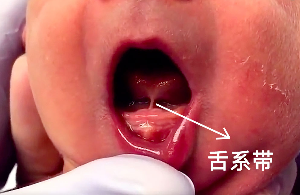 听说宝宝舌系带短影响吃奶，有必要剪一刀吗？