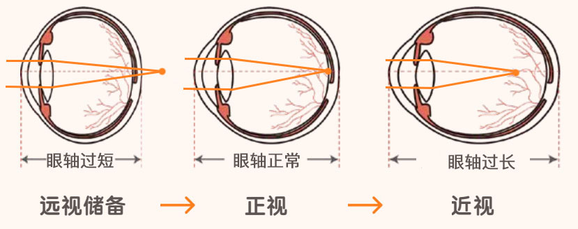 卫健委：2岁后要查远视储备，看孩子近视的可能性