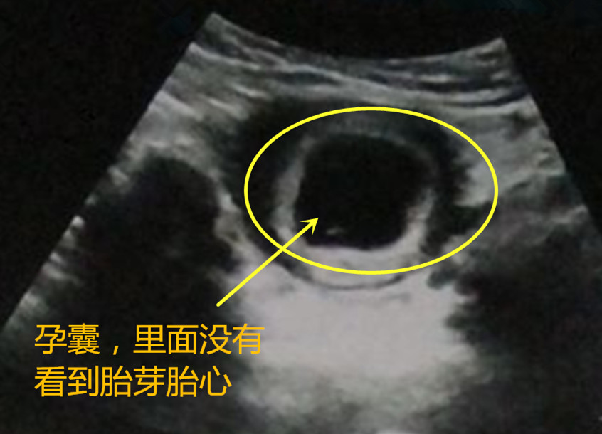 怀孕后多久可以看到胎芽和胎心？