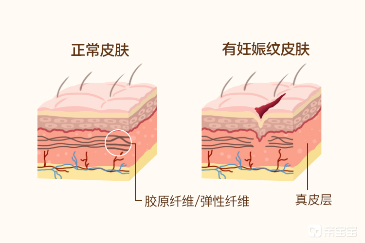 那些不长妊娠纹的准妈妈，是怎么做到的？
