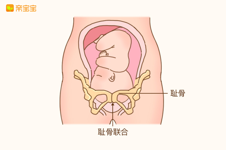 耻骨痛：准妈妈闻之色变的疼痛之一