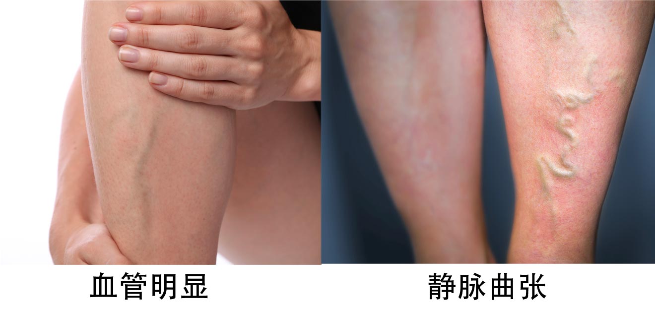 静脉变化：皮肤上的“交通网”