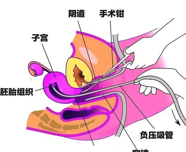 孕中孕延产小说_青楼虐孕延产塞延产棒_孕产避孕节育状况