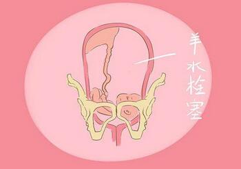 羊水栓塞死亡率极高 哪些孕妇最容易出现